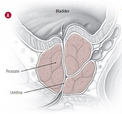 How BPH Works A thumb